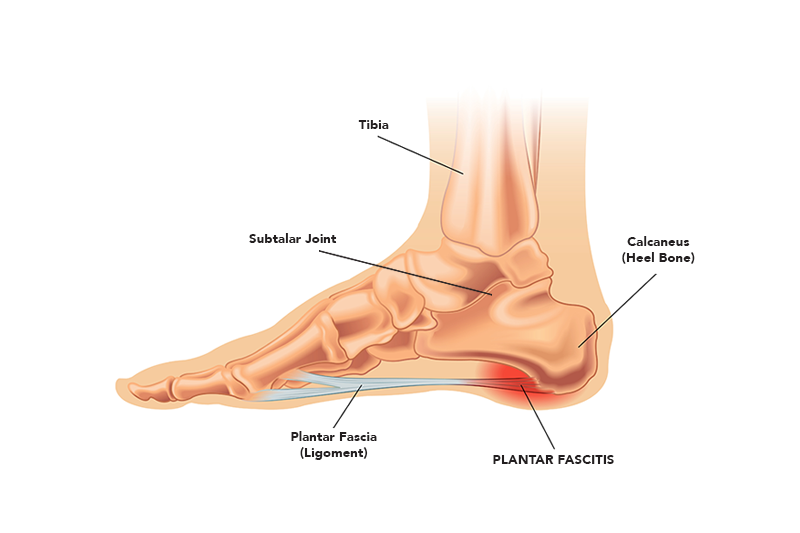 Plantar-fasciitis-Image-2.png